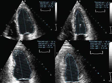 an echocardiogram bad test results.